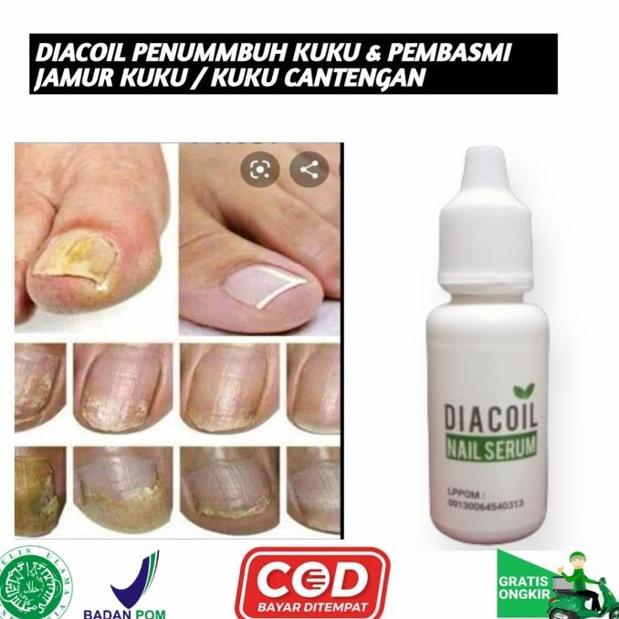 Diacoil Penumbuh Kuku & Pembasmi Jamur Kuku Serta Obat Kuku Cantengan