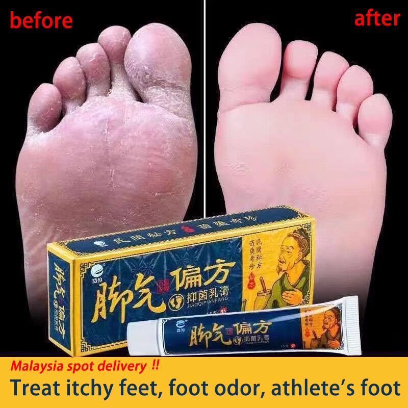 [100% Asli ] Mengobati tinea pedis, salep tinea pedis, tinea pedis, kaki gatal, kaki bau, kulit meng