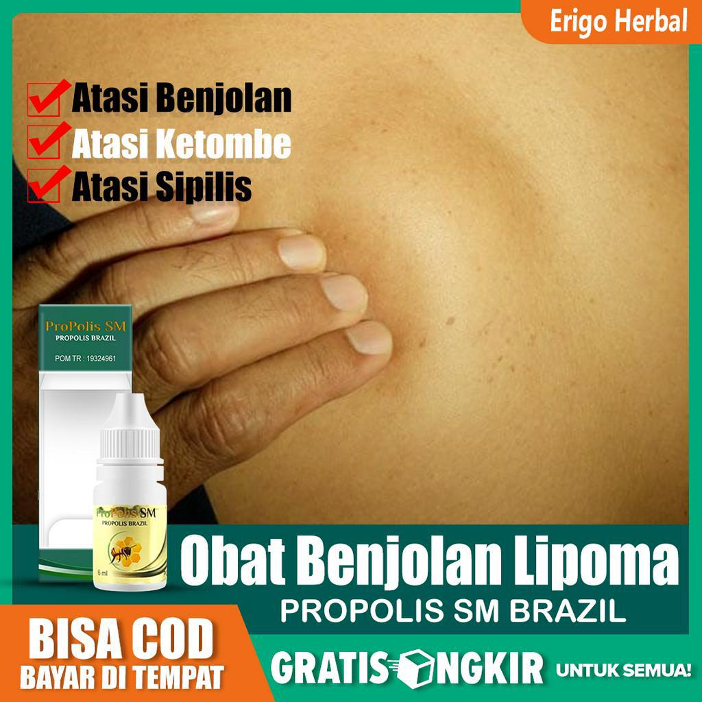 

Obat Benjolan Lipoma, Gondok, Benjolan Abnormal, hipertiroid Herbal Propolis SM Asli di Tangerang