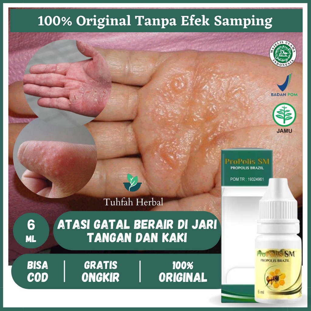 Obat Gatal Berair Kulit, Obat Gatal Kulit, Obat Gatal Berair Di Jari Tangan Dan Kaki, Obat Gatal Di 