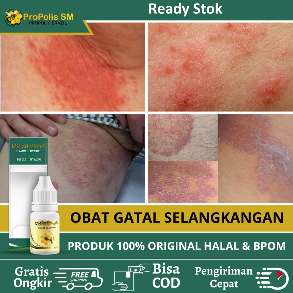 Obat Gatal Selangkangan, Obat Selangkangan Lecet Berjamur, Obat Gatal Selangkangan Berjamur, Obat In