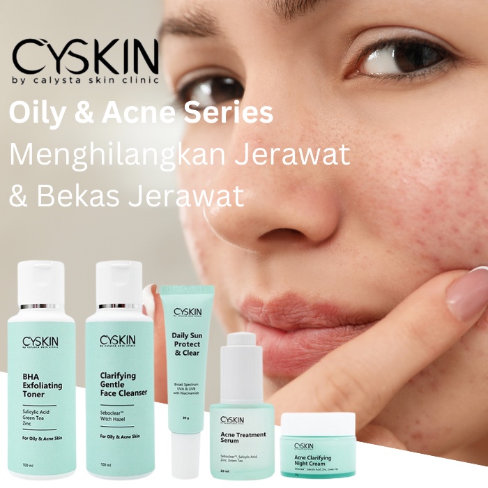 Skincare Atasi Jerawat Radang Calysta
