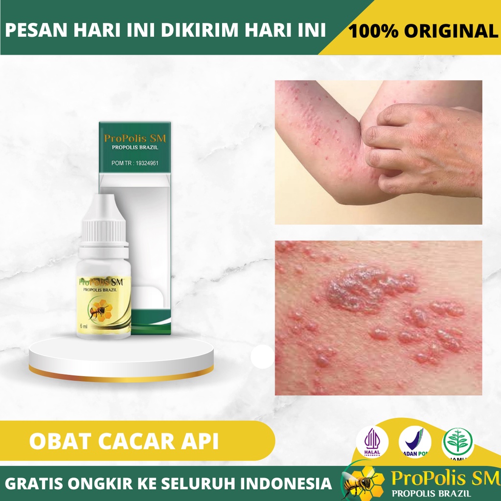 Obat Cacar Api, Cacar Air, Cacar Monyet, Obat Cacar Bernanah, Penghilang Bekas Cacar Hitam, Obat Cac