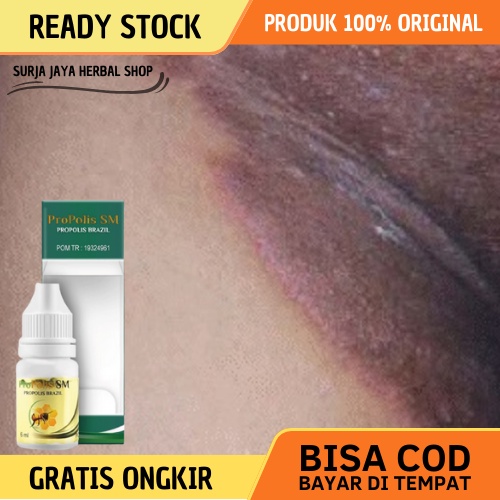 Obat Gatal Selangkangan, Obat Selangkangan Menghitam dan Gatal, Obat Selangkangan Lecet Berjamur, Ob