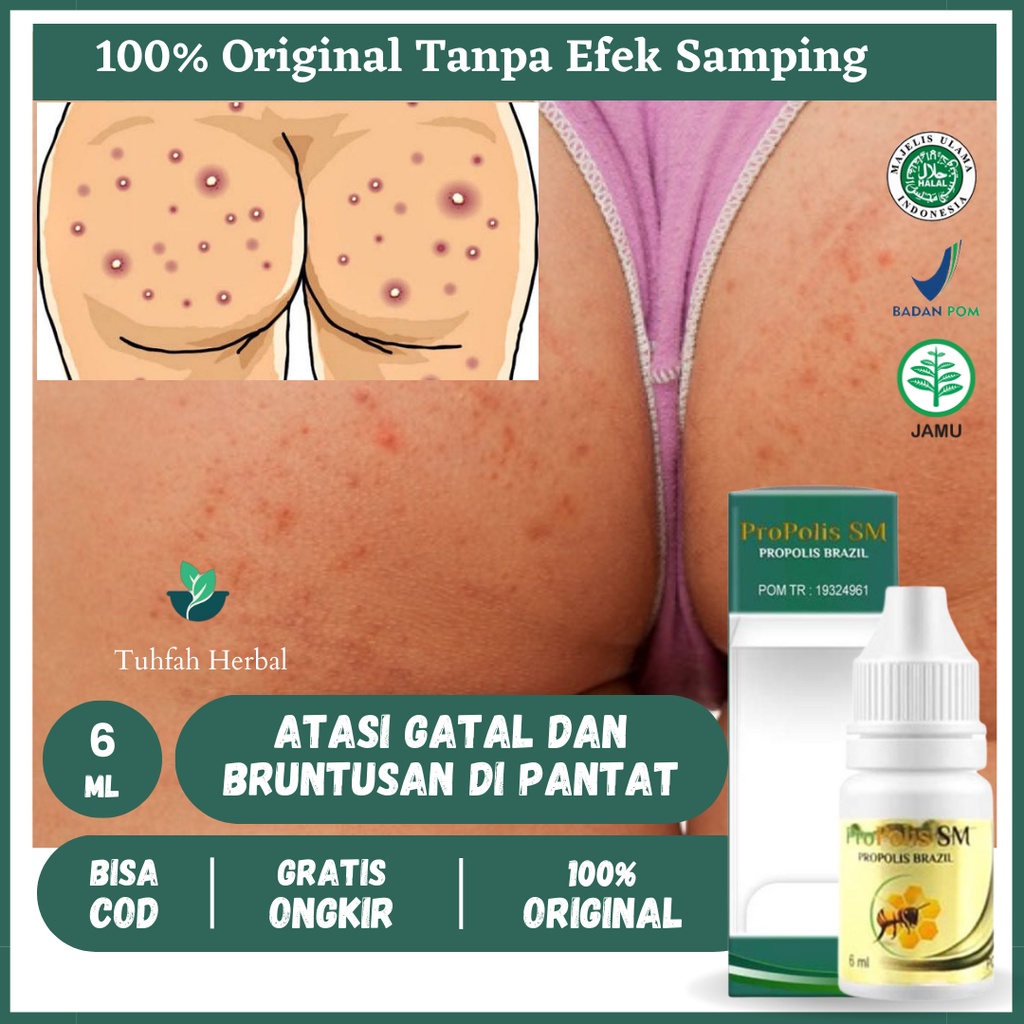 Obat Gatal Pantat, Obat Pantat Burik, Obat Pantat Bruntusan, Obat Jerawat Di Pantat, Koreng Hitam Di