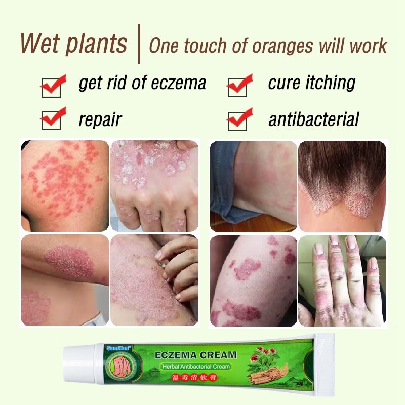 Salep gatal Salep Eksim Salep kulit Krim psoriasis paling ampuh Kulit Kepala Psoriasis Tangan Tinea Kaki Bau Versicolor Menghambat Dermatitis Jamur Anti Gatal Cream 20g