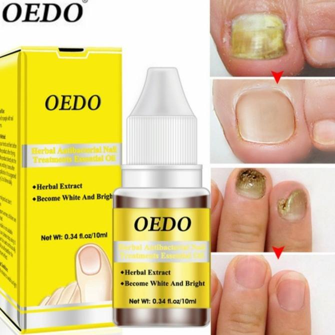 Oedo Minyak Herbal Antibakteri Esens Perawatan Kuku Jamur Kaki Tangan