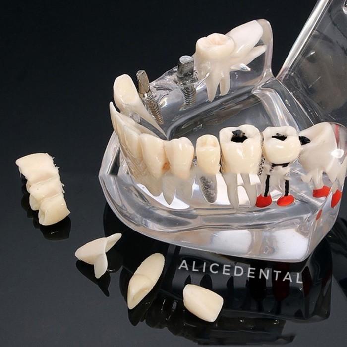 Model Studi Gigi Implant Crown Bridge Bening Transparan Phantom Dental