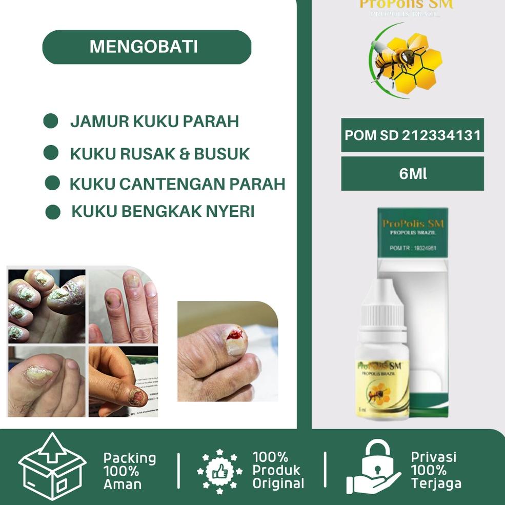 DISCOUNT  Obat Tetes Jamur Kuku, Obat Jamur Kuku Kaki Dan Tangan, Obat Infeksi Jamur Kuku, Obat Kuku