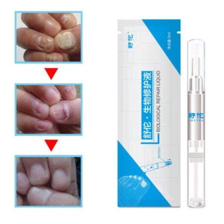 [FLASH SALE !!!] Obat kuku jamur dan rusak busuk berjamur jamuran paling ampuh - Obat Jmur kuku tang