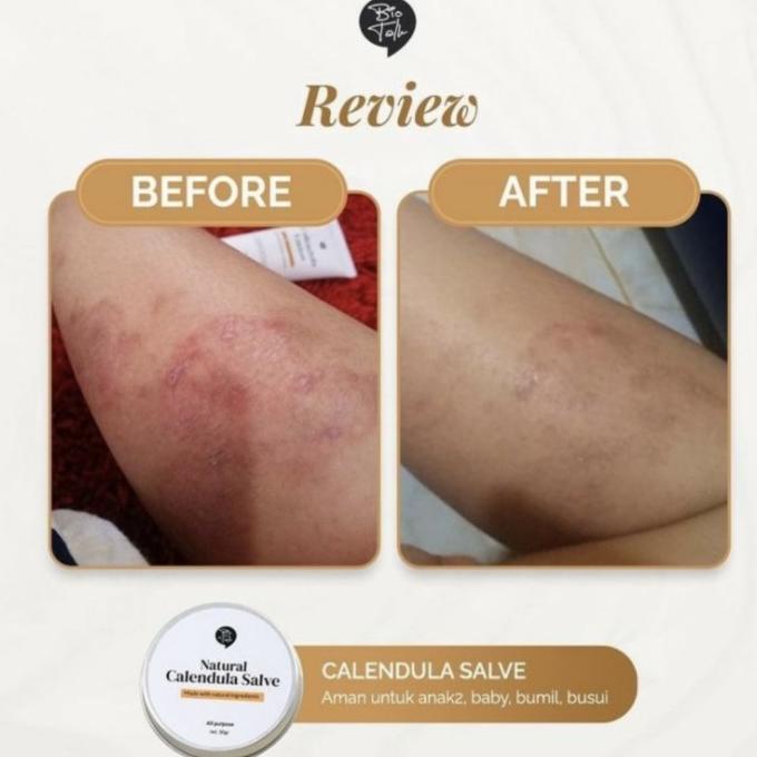 BIOTALK Calendula Healing Salve For Eczema Dry Skin-Cream Bekas Luka