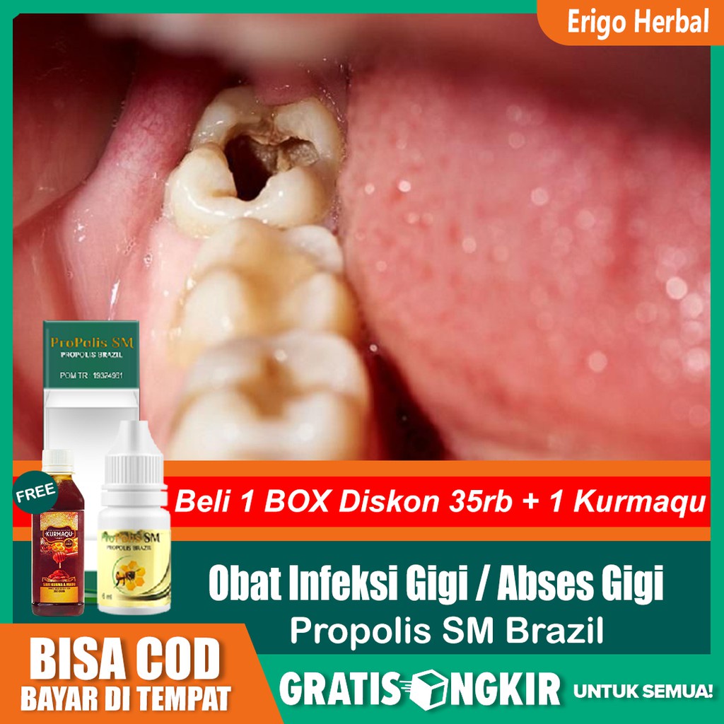 Obat Infeksi Gigi - Abses Gigi - Sakit Gigi - Radang Gusi - Gigi Berlubang Propolis Sm di Tangerang