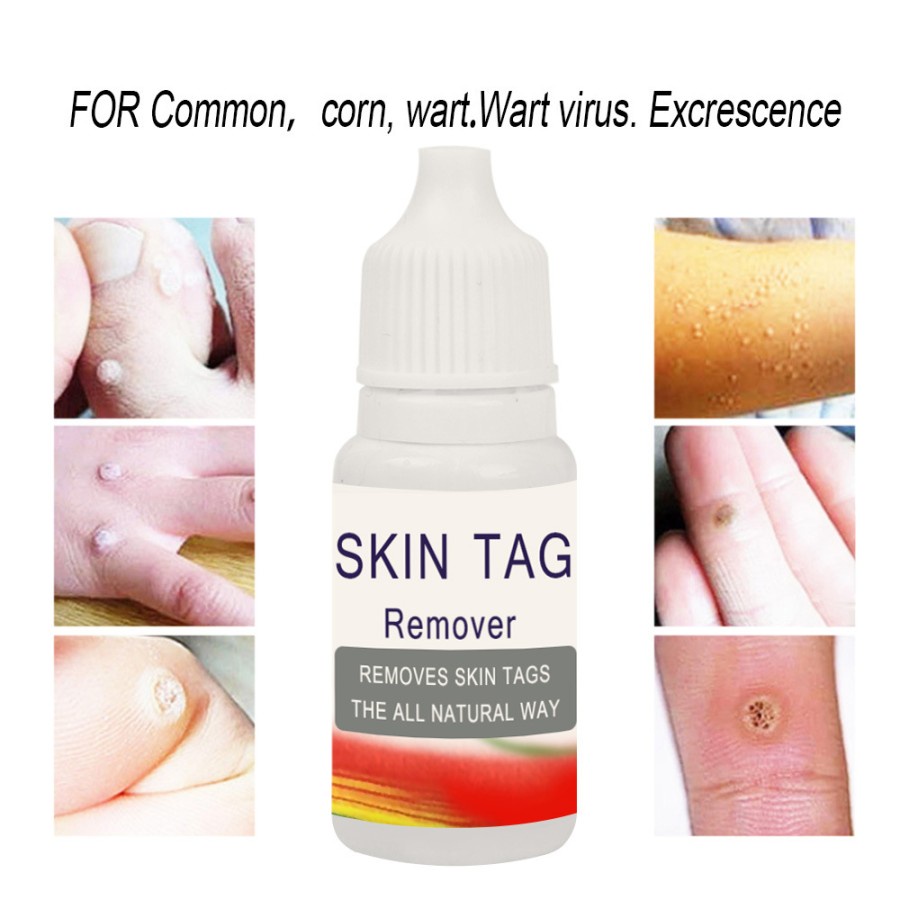 Skin Tag Remover penghilang kutil tahi lalat