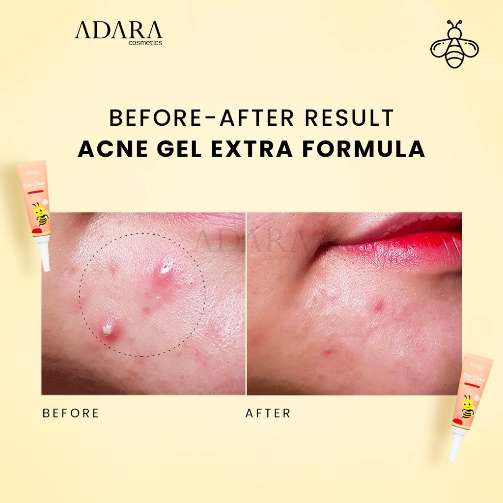 ❤️ MEMEY ❤️ ADARA Bee Clear Acne Gel Extra Formula | Regular