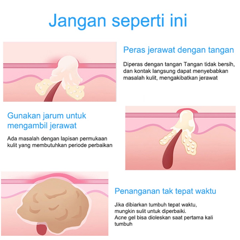 Serum Acne Obat Jerawat Obat Totol Jerawat 30g Herbal Obat Jerawat Dan Bekas Jerawat Obat Jerawat Dan Bekas Jerawat Paling Ampuh