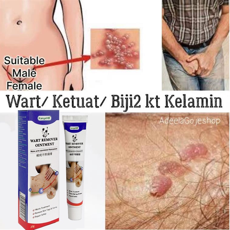 Skin tag remover Obat kutil Wart Remover salep kutil kelamin 20ml skin tag remover obat salep kutil kelamin untuk wajah leher papilloma condyloma acuminatum Warts skin tag