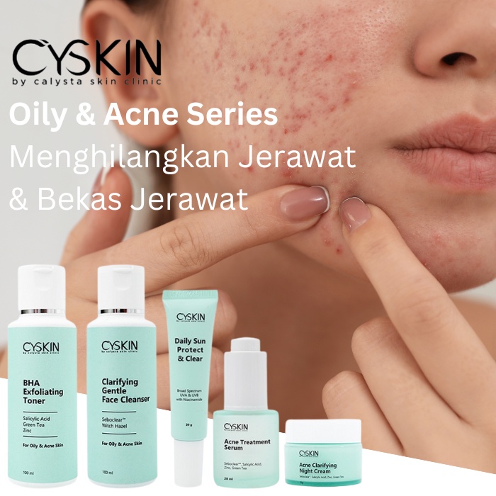 Anti Acne Asli Calysta Skin Care Atasi Flek Hitam