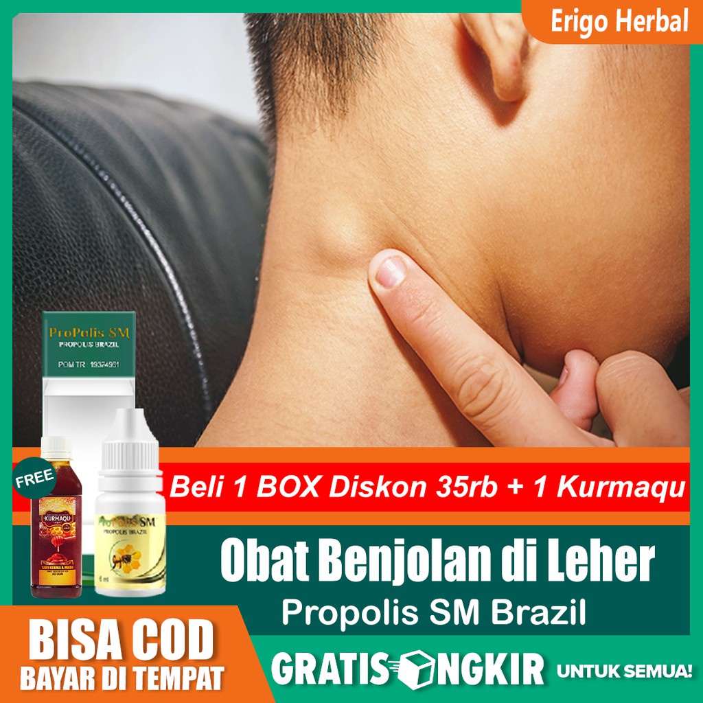

Obat Benjolan di Leher, Gondok, Hipertiroid Tiroid Bengkak Herbal Propolis SM Brazil Di Tangerang