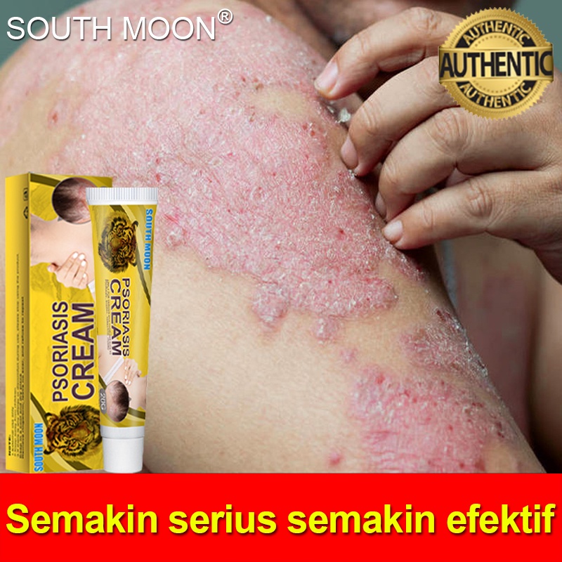 Gatal-Psoriasis Cream 20g Perawatan Kulit Herbal Cina Efektif Mengobati Infeksi Jamur / Kulit Gatal 