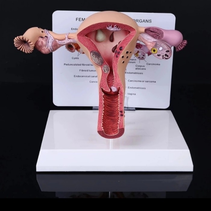 MANEKIN ALAT PERAGA MODEL ANATOMI HUMAN FEMALE UTERUS OVARY DISEASE