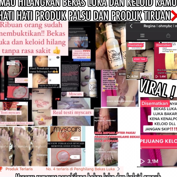 (H✓99»] MYSCARS PENGHILANG KELOID | PENGILANG BEKAS LUKA AMPUH | OBAT KELOID | SALEP KELOID | CREAM 