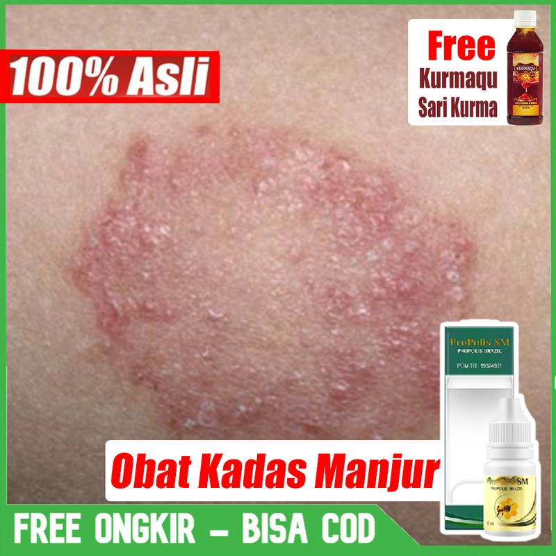 Obat Kurap Cair - Obat Kurap dan Gatal - Obat Kurap Menahun - Bisa Untuk Bayi PROPOLIS SM