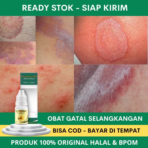 Obat Selangkangan Hitam - Obat Selangkangan Hitam dan Berjamur - Obat Selangkangan Lecet - Obat Gata