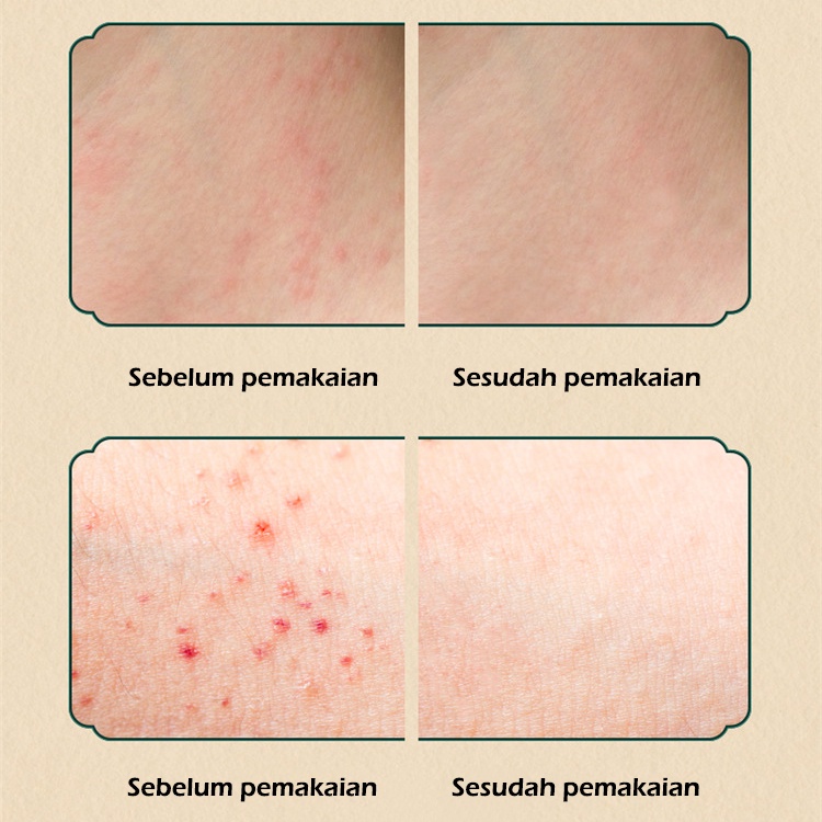 【100% ASLI】[BPOM]&amp;[COD]krim obat herbal alami mengatasi gatal, salep anti pruritus, salep eksim, salep kulit, salep antinprirutus paling efektif, salep psoriasis, psoriasis kulit kepala, kurap tangan, kulit infeksi jamur