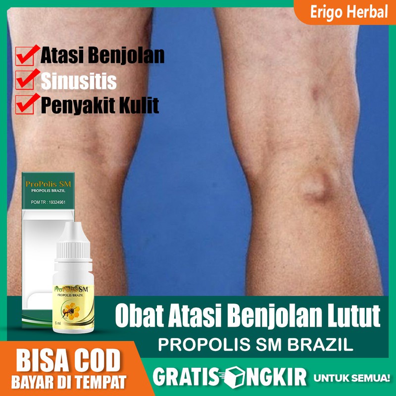 Obat Benjolan Lutut, Kista Baker, Benjolan Belakang Lutut Dengan Propolis SM ASLI Di Tangerang