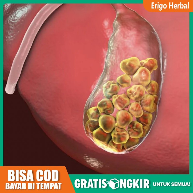 Obat Batu Empedu - Sakit Perut Bagian Kanan Atas - Sakit Di Bahu QNC Jelly Gamat Original