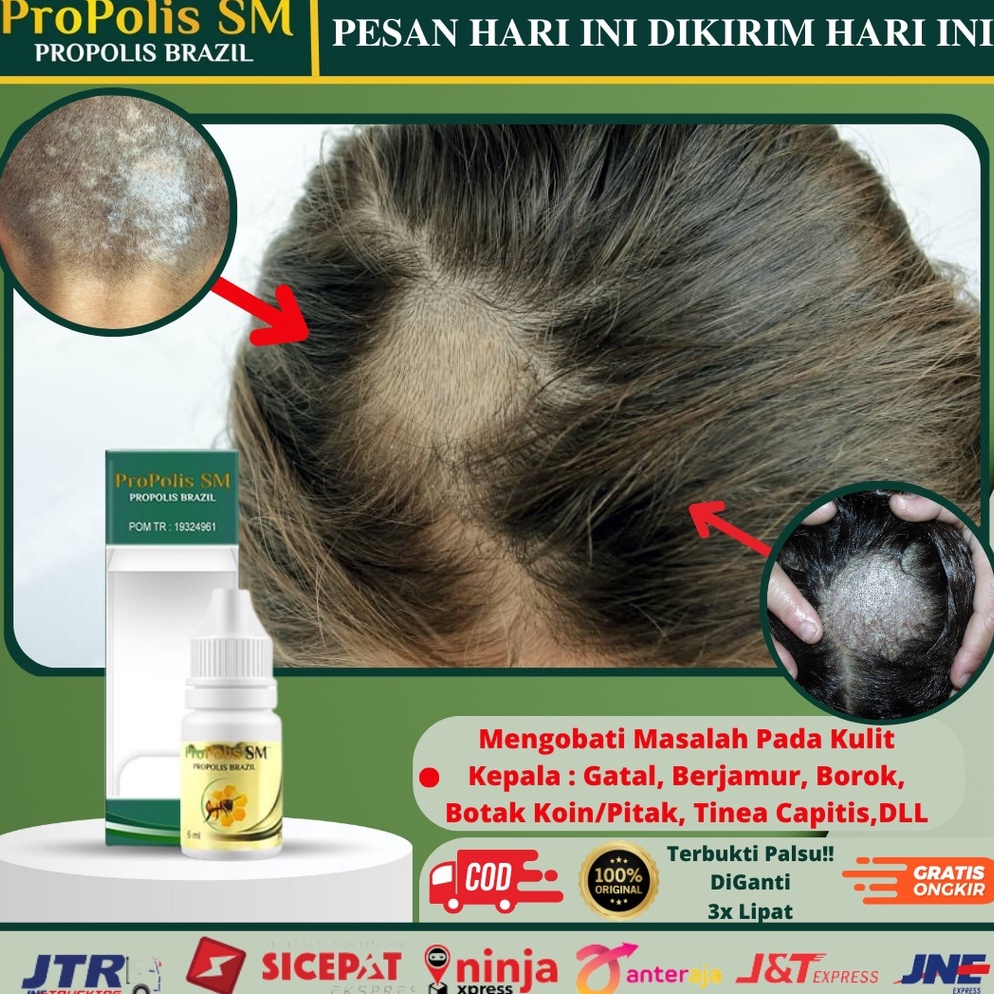 CodeJj8J3 Obat Oles Jamur Di Kulit Kepala, Kepala Berjamur, Gatal, Kulit Autoimun, Obat Botak Koin, 