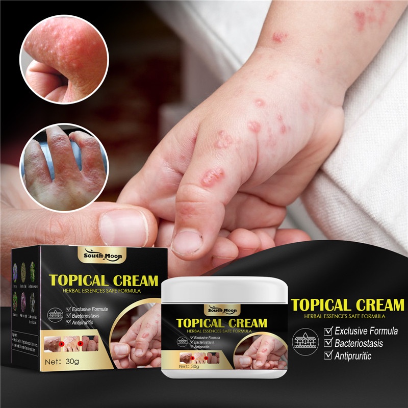 【COD】Lepuhan Keringat Anti-gatal Tangan dan Kaki Krim Topikal Psoriasis Krim Topikal Dermatitis Eczematoid Salep Eksim 30G