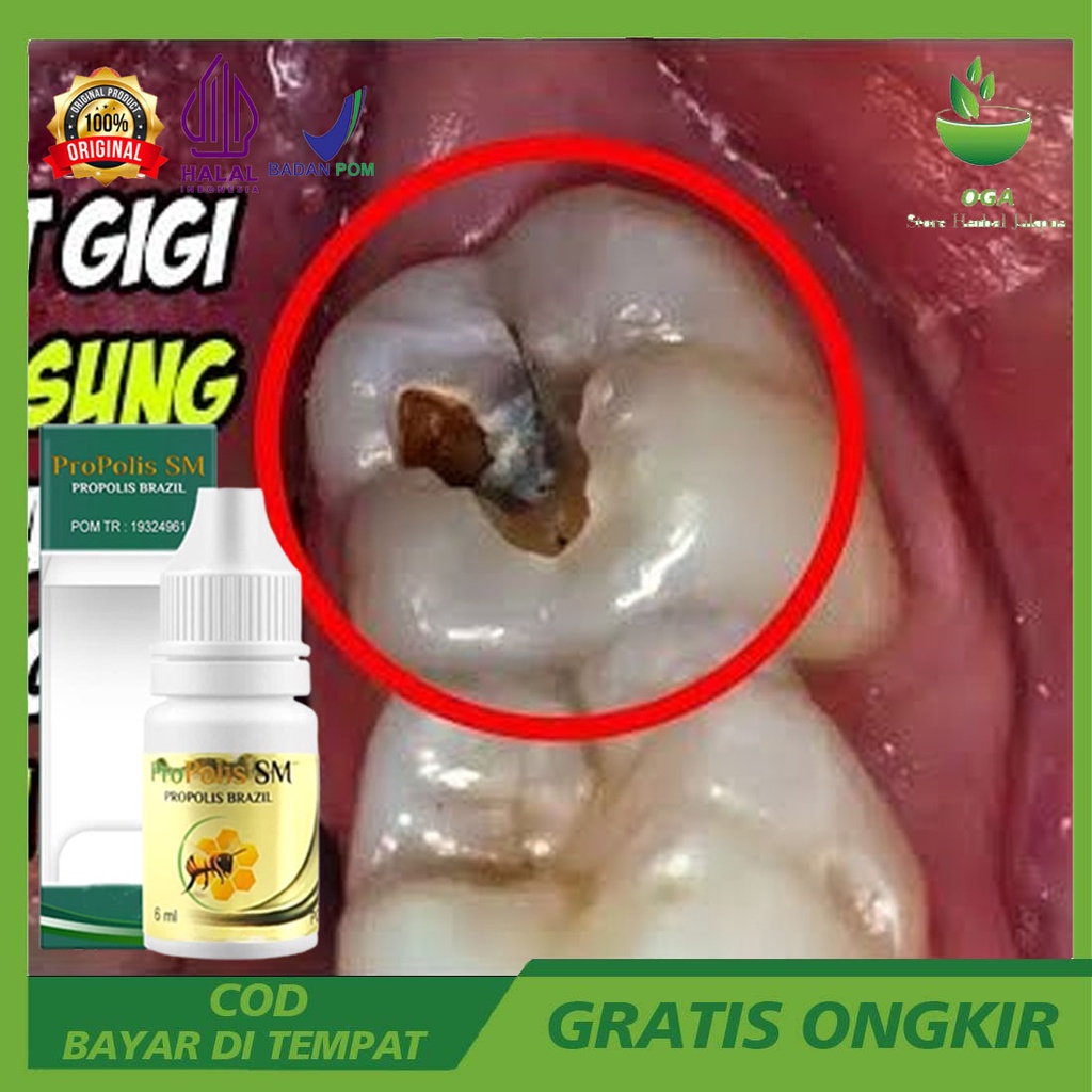 Obat Sakit Gigi Biar Ulat Keluar - Cara Menghilangkan Ulat Gigi Secara Alami - Cara Mengeluarkan Ula