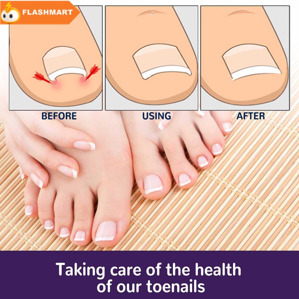 FLASHMART Stiker Korektor Kuku Kaki Adhesive Ingrown Toenail Patch 50 PCS - EH-50