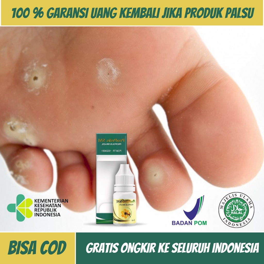 Obat Mata Ikan Telapak Kaki dan Tangan Herbal, Obat Penghilang Mata Ikan Telapak Kaki, Obat Penghanc