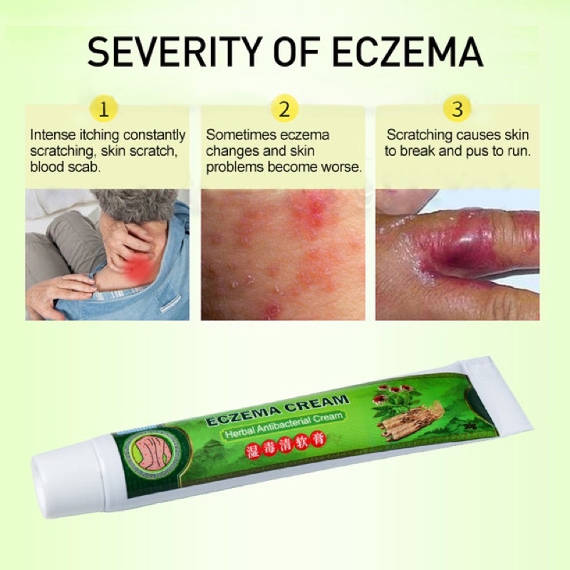 Salep gatal Salep Eksim Salep kulit Krim psoriasis paling ampuh Kulit Kepala Psoriasis Tangan Tinea Kaki Bau Versicolor Menghambat Dermatitis Jamur Anti Gatal Cream 20g