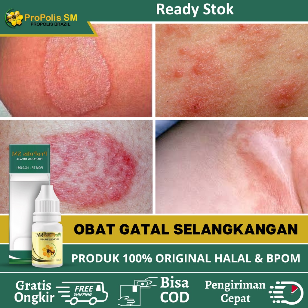 Obat Hitam Selangkangan, Obat Penghilang Selangkangan Hitam, Obat Gatal Selangkangan, Salep Gatal Se