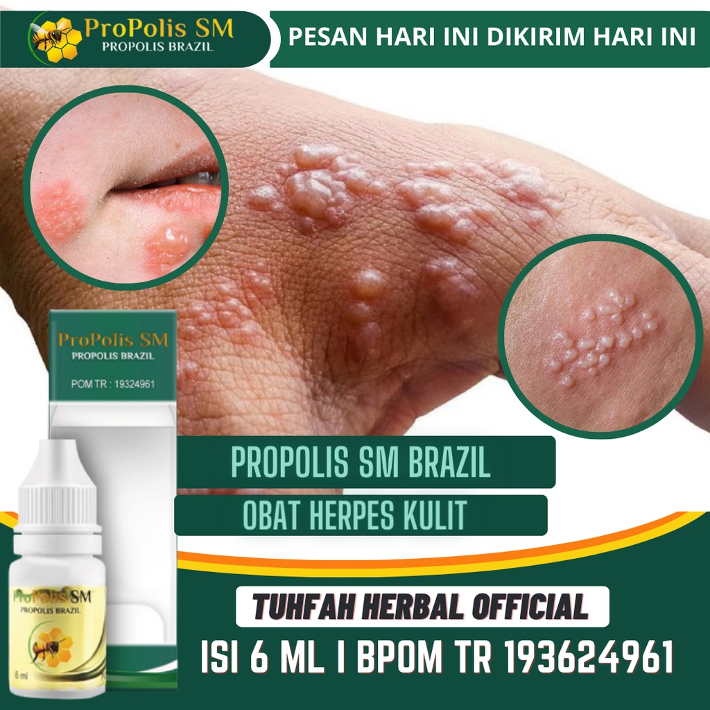 Obat Herpes Kulit, Obat Oles Herpes Bayi Anak Dewasa, Herpes Zoster, Herpes Kulit, Herpes Bibir, Her