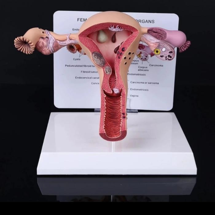Terlaris Manekin Alat Peraga Model Anatomi Human Female Uterus Ovary Disease