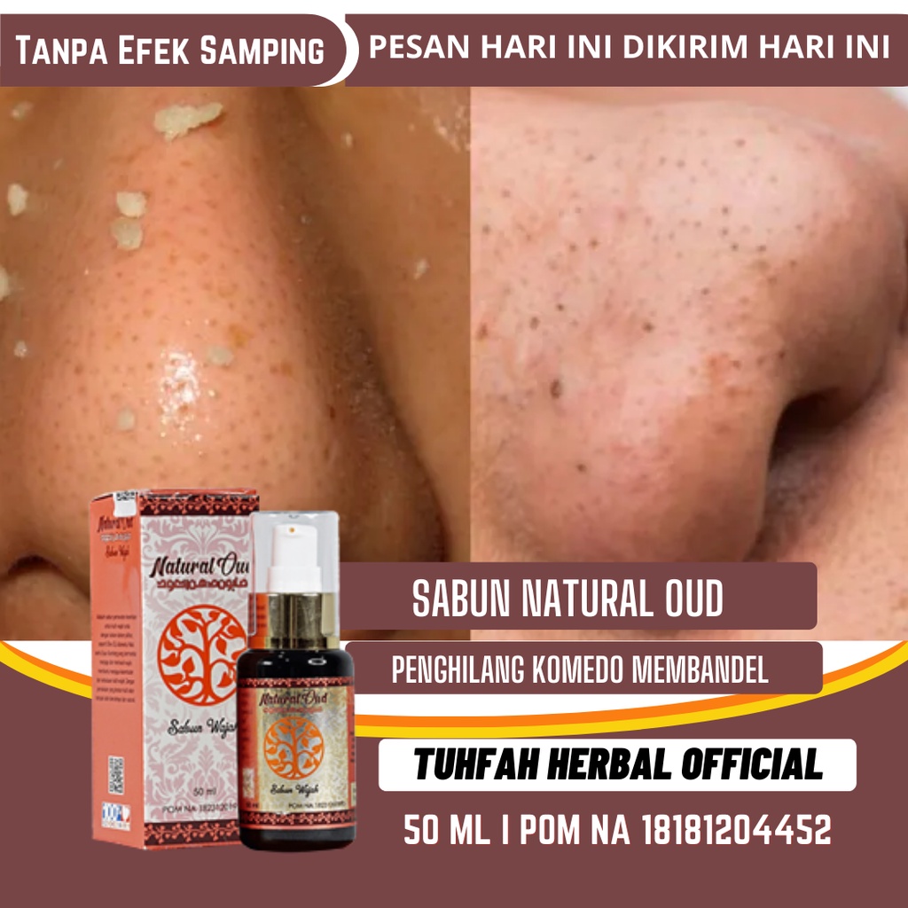 Hilangkan Komedo Membandel di Wajah, Sabun Penghilang Komedo, Sabun Muka Komedo, Komedo di Hidung, K