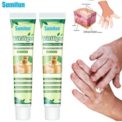 Obat Salep Penghilang Bercak Putih Vitiligo - Obat Vitiligo Salep Cream Belang Bercak Putih di Kulit