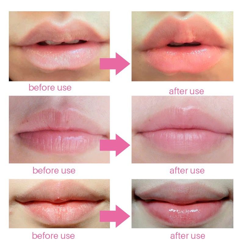 VS BG -MASKER BIBIR COLLAGEN Pelembab Mulut Kering Pecah Lip Mask Moisturizing Moist Halus Lembut