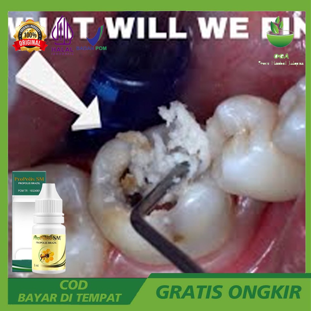 Cara Menghilangkan Ulat Pada Gigi - Ulat Gigi Manusia - Ulat Gigi Busuk - Ulat Gigi Bolong Dengan Pr