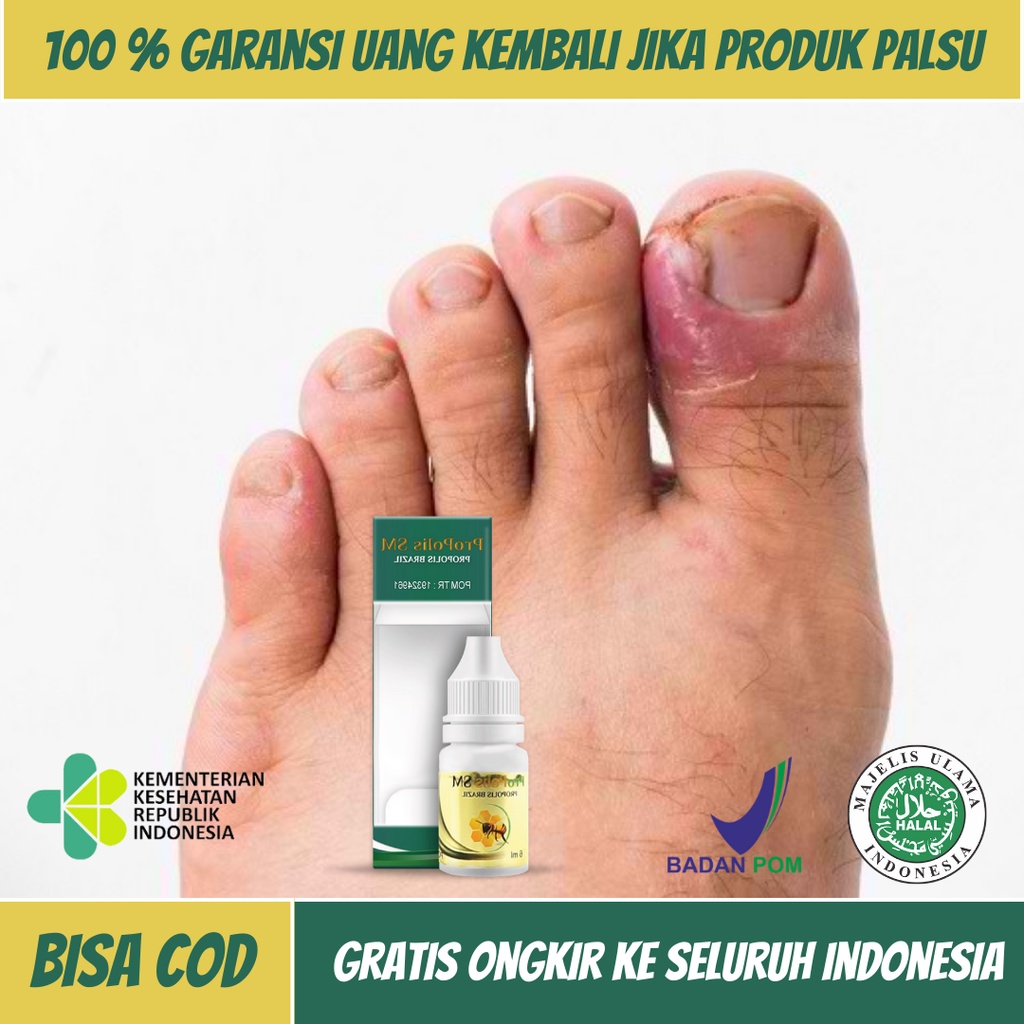 Obat Kuku Cantengan, Obat Cantengan Jempol Kaki, Obat Cantengan Di Jempol Kaki, Obat Kuku Kaki Cante