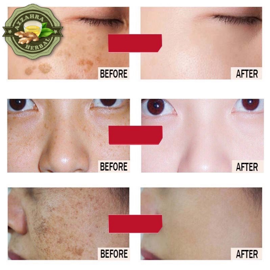 𝐎𝐑𝐈𝐆𝐈𝐍𝐀𝐋 Whitening Freckle Cream Remove Dark Spots Anti Penuaan Dini Penghilang Flek/Jerawat/Bintik Noda Hitam Komedo