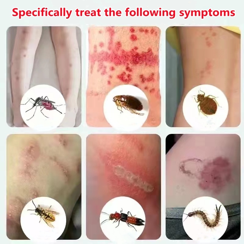 [100% Asli ] Salep gatal Obat gatal paling ampuh Obat gatal kulit 20g Anti gatal cepat/krim  gigitan nyamuk anti-gatal/Balsem gigitan tungau/menghilangkan pembengkakan/Bumil dan bayi dapat menggunakan