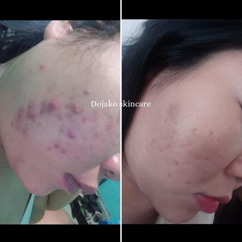 Promo - SERUM ACNE SERUM TOTOl JERAWAT AHA BHA DOJAKO IMPORT ..