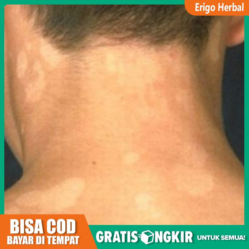 Obat Gatal Panu - Panuan - Obat Gatal Karena Panu QNC JELLY GAMAT ORIGINAL