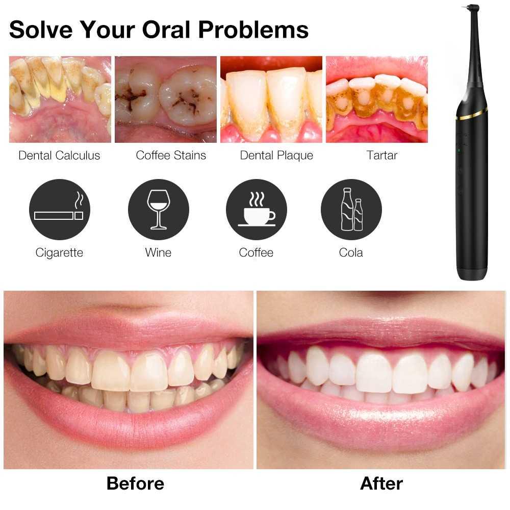 ExCorn Pembersih Gigi Elektrik Dental Tartar Remover LR-6 Behel Gigi Behel Gigi Vitamin Gigi Anak Vitamin Gigi Anak Perapi Gigi Anak Perapi Gigi Anak Perawatan Gigi Behel Perawatan Gigi Behel Perawatan Gigi Anak Perawatan Gigi Anak Perapih Gigi Anak Perap