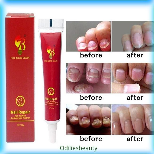 Salep Anti Jamur Kuku Onikomikosis Paronychia Herbal Cina 20 Gr